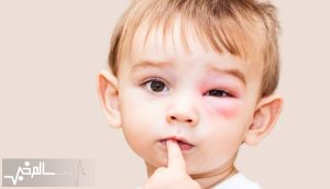  آلرژی یکی از بیماری‌های شایع کودکان است