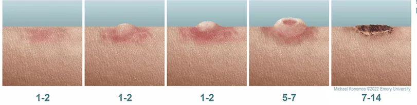 بروز بثورات پوستی در طول دوره بیماری