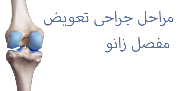 مراحل جراحی تعویض مفصل زانو