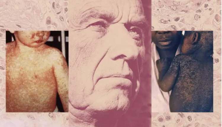 دستور دور از انتظار وزیر؛ به جای واکسیناسیون، دنبال روغن کبد ماهی بگردید!