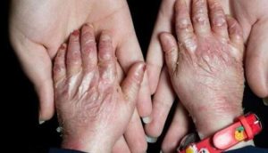 تجدید فراخوان تامین پانسمان‌های بیماران پروانه ای