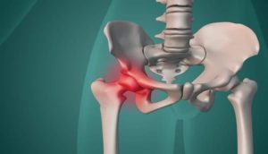 نادیده گرفتن درد ران و لگن منجر به آرتروز و جراحی تعویض مفصل منجر شود